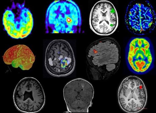 Neuroradiologi