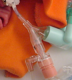 Intubation