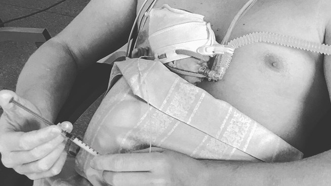 tube feeding