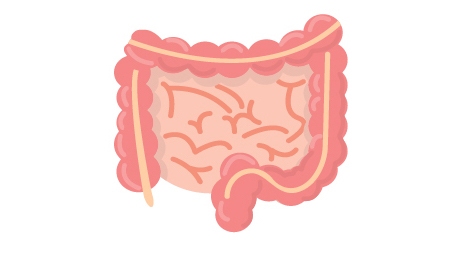 Necrotising enterocolitis (NEC)