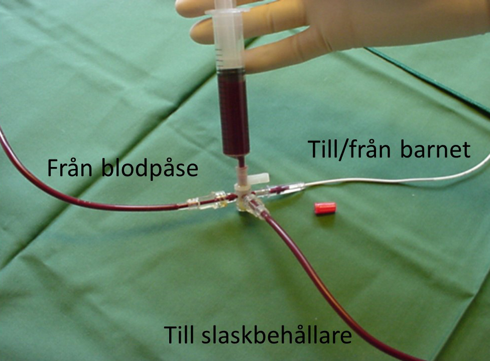 Exchange transfusion