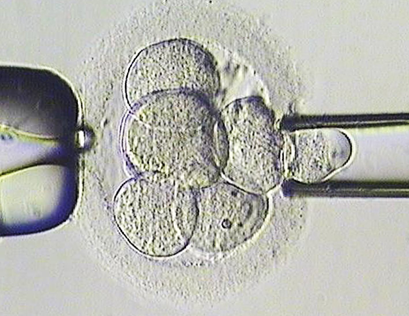 En cell tas från ett embryo för genetisk analys. Görs för familjer med ärftliga svåra sjukdomar.  Det är en så kallad preimplantatorisk  genetisk analys.