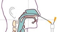 Provtagning nasofarynxaspirat